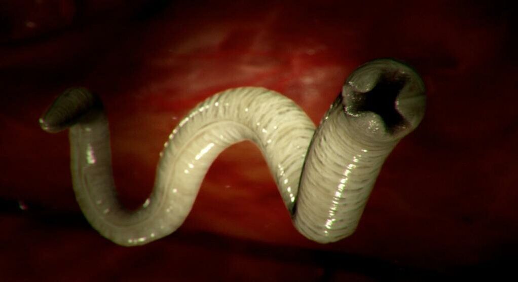 Worm from the human body
