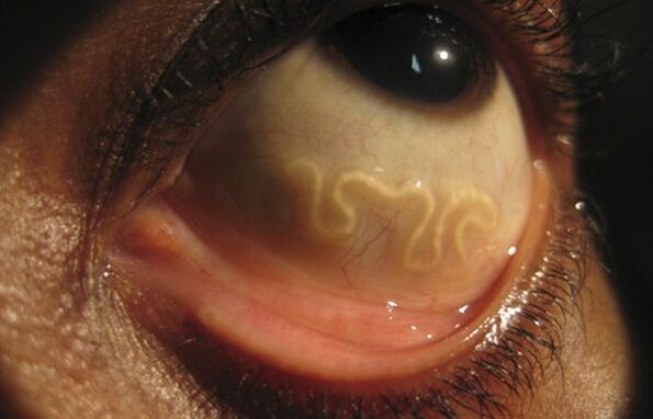 The loa loa worm lives in the human eye and causes blindness